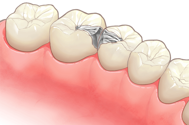 長野市 若穂歯科 詰め物