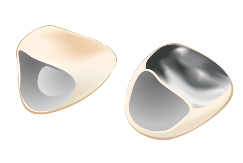 長野市 若穂歯科 被せ物